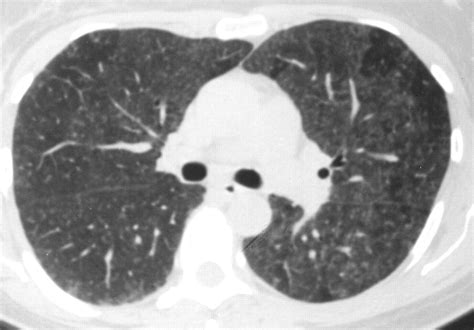 suspicious densities in both upper lobes|Ground glass opacity: Causes, symptoms, and .